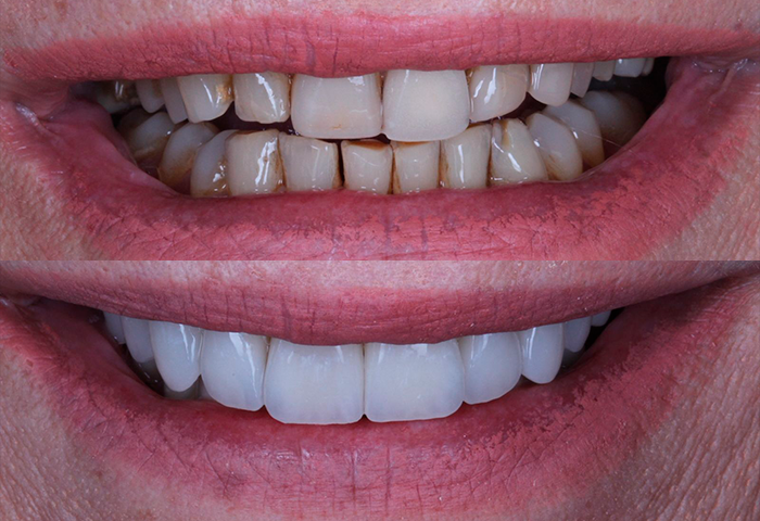 Lentes em Porcelana — Bem Estar Odontologia